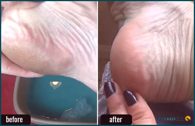 Listerine Foot Soak antes y después de las fotos-1