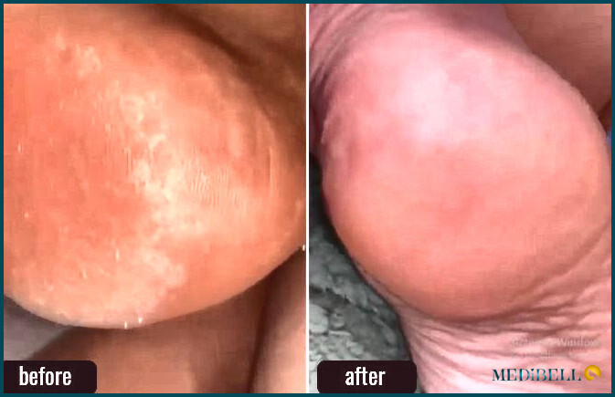 Listerine Foot Soak antes y después de las fotos