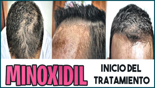 🏆es efectivo el minoxidil para la caida del cabello