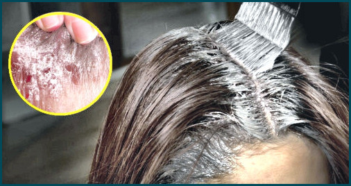 👍tintes de pelo para psoriasis