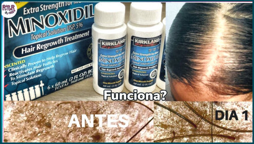 🔝dónde adquirir minoxidil kirkland funciona para el cabello